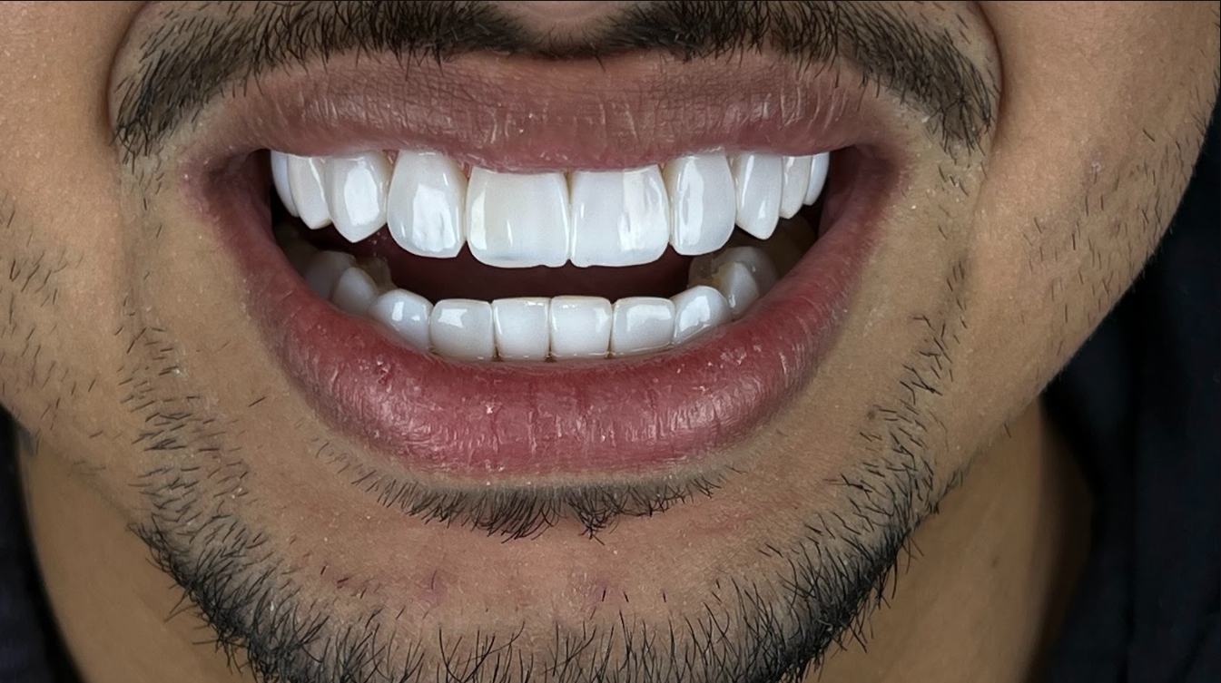 Depois das lentes em resina