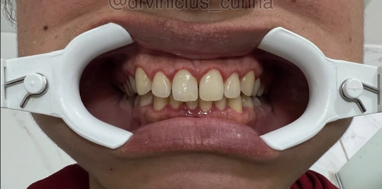 Depois da gengivoplastia