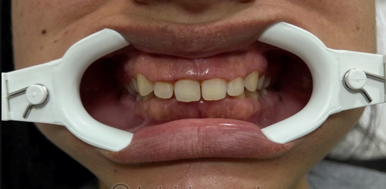 Antes da gengivoplastia